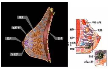 针刀治疗乳腺增生症