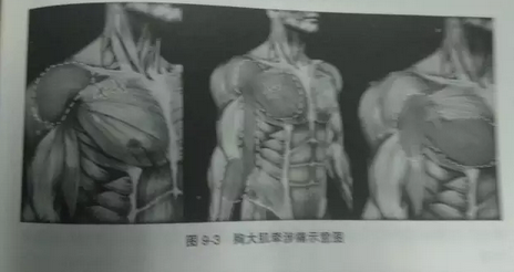 针刀治疗乳腺增生症